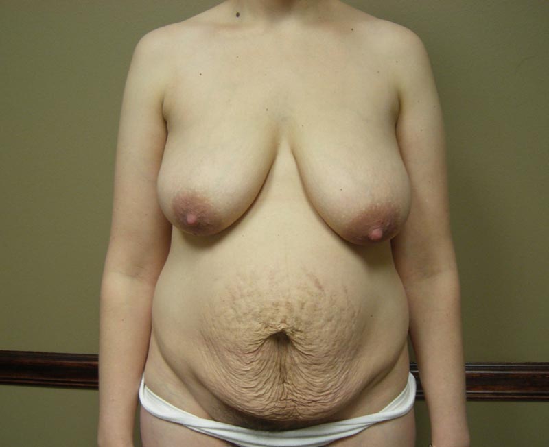 tummy tuck patient before photo front view