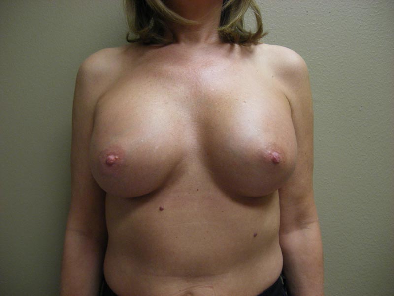 breast augmentation after photo front view