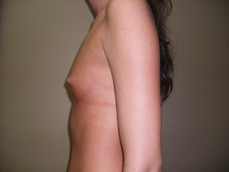 breast augmentation before photo side view
