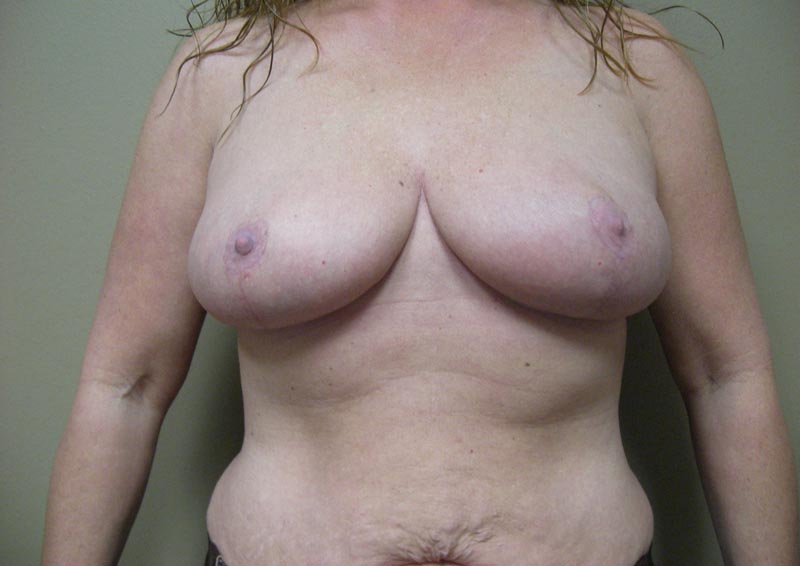 breast lift after photo front view