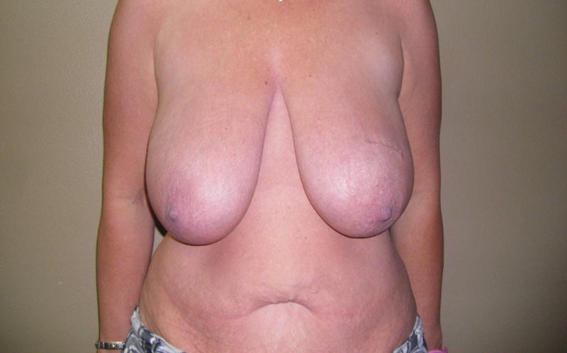 breast reduction before photo front view