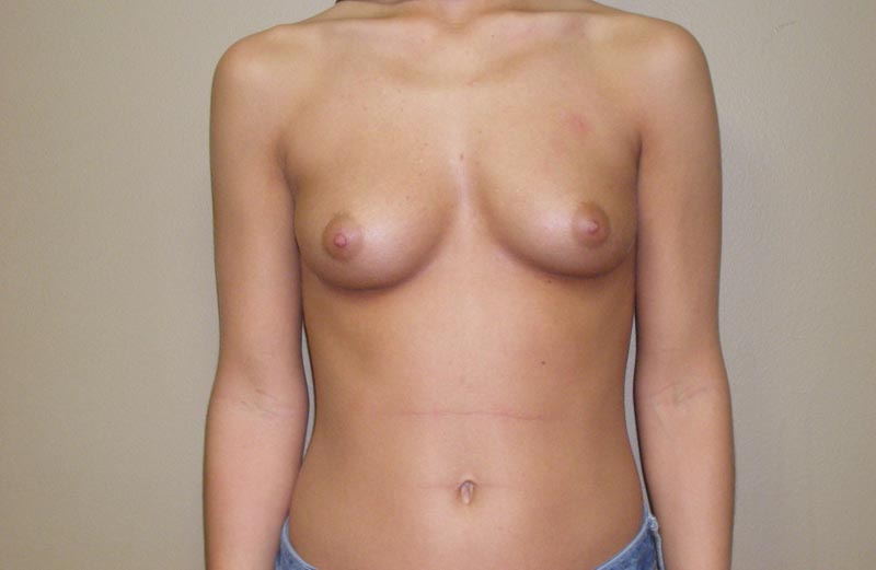 breast augmentation before photo front view