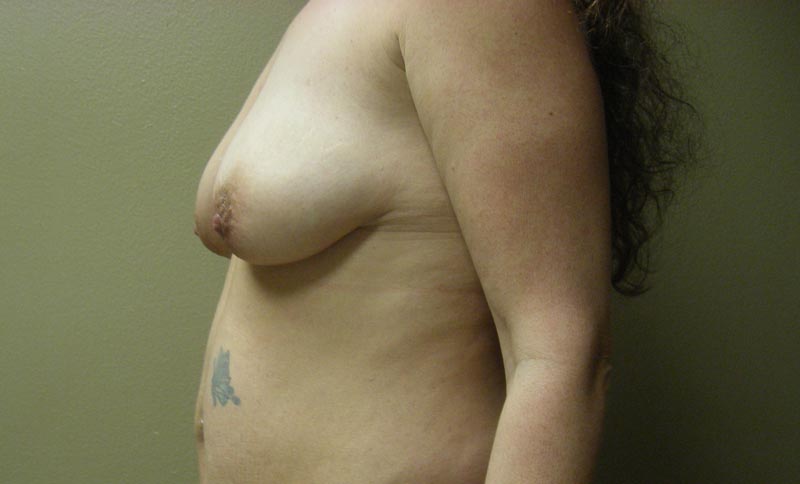 breast lift with augmentation before photo side view