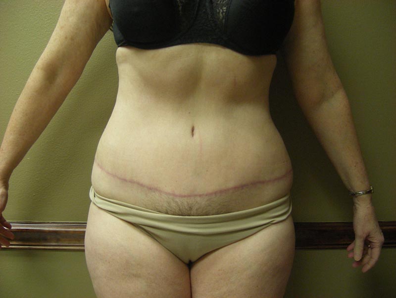 tummy tuck patient after photo front view
