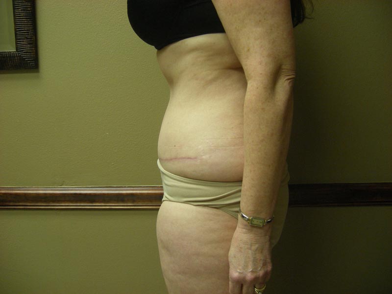 tummy tuck patient after photo side view