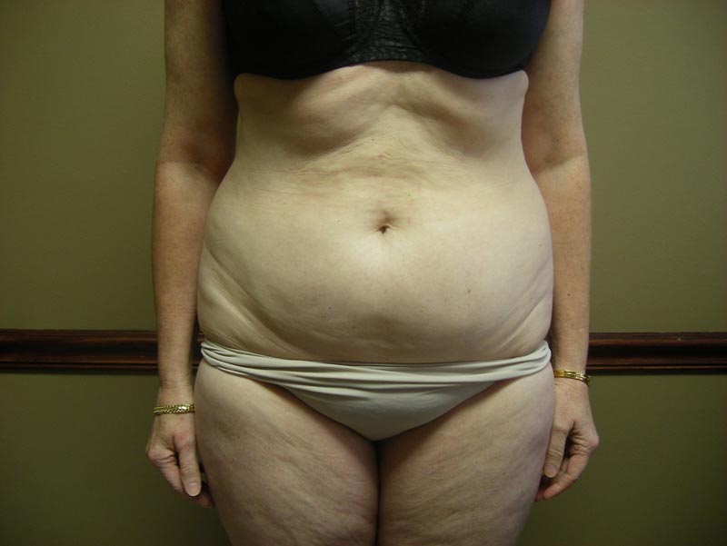 tummy tuck patient before photo front view