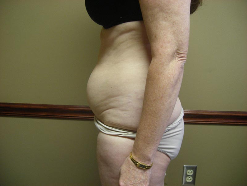 tummy tuck patient before photo side view