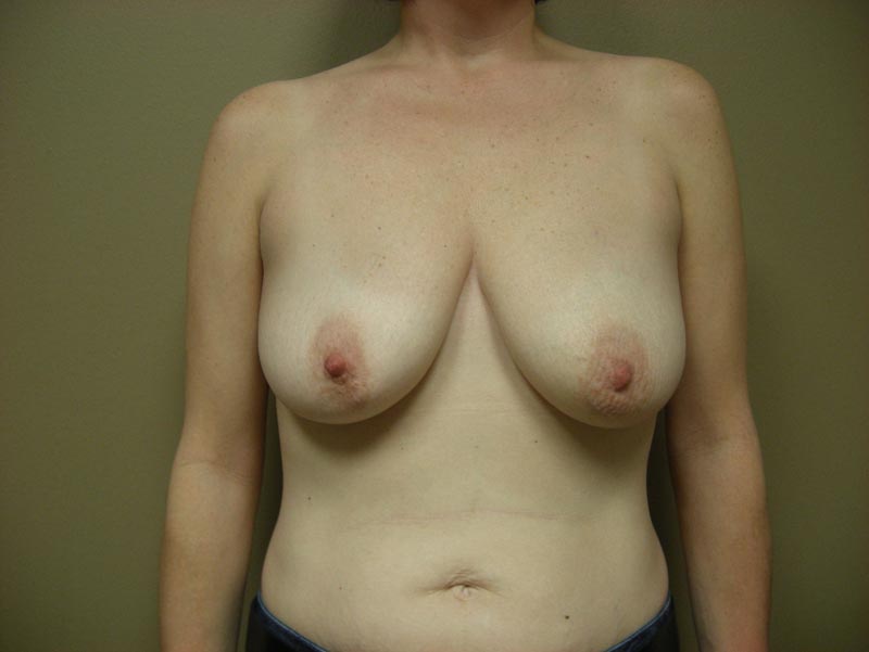 breast lift with augmentation before photo front view