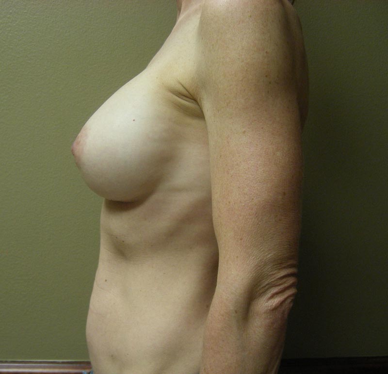 breast augmentation after photo side view