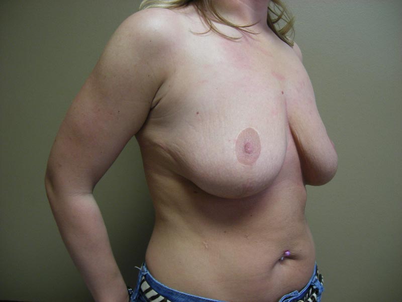 breast lift with augmentation before photo side view