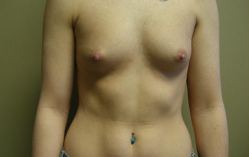 breast augmentation before photo front view