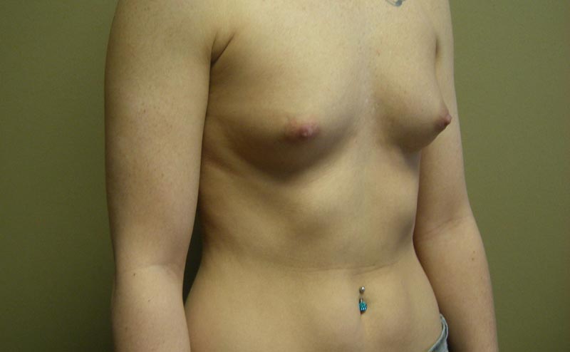 breast augmentation before photo side view