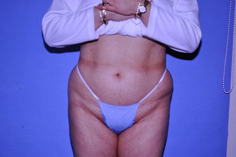 liposuction patient before photo front view