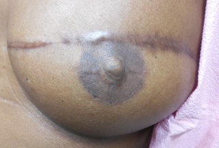 nipple tattooing with breast reduction after photo