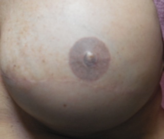 nipple tattooing with nipple reconstruction