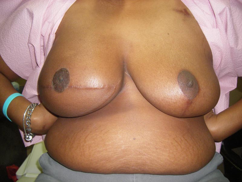 breast reconstruction before photo front view