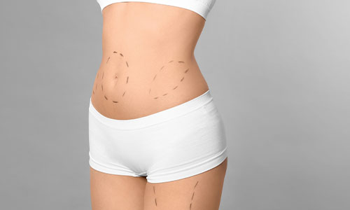 markings on body for liposuction procedure